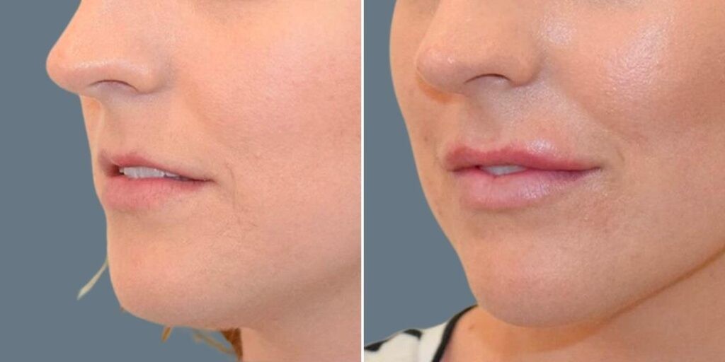 Face Lip Enhancement Female Pre2024 029 Before And After