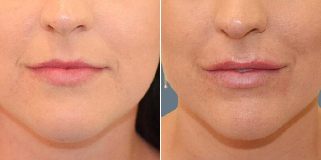 Face Lip Enhancement Female Pre2024 030 Before And After