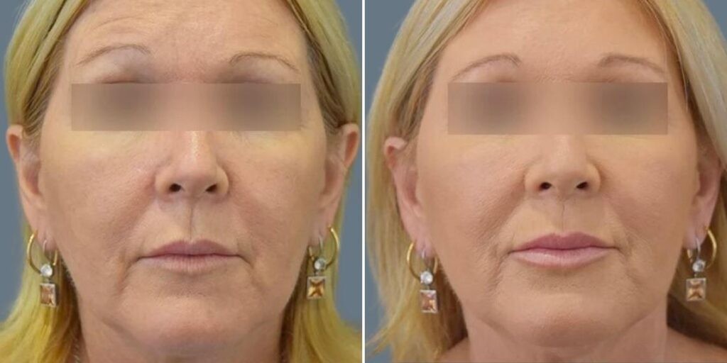 Face Lip Enhancement Female Pre2024 031 Before And After