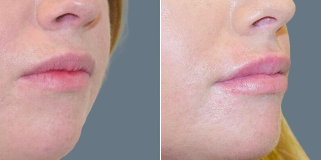 Face Lip Enhancement Female Pre2024 032 Before And After