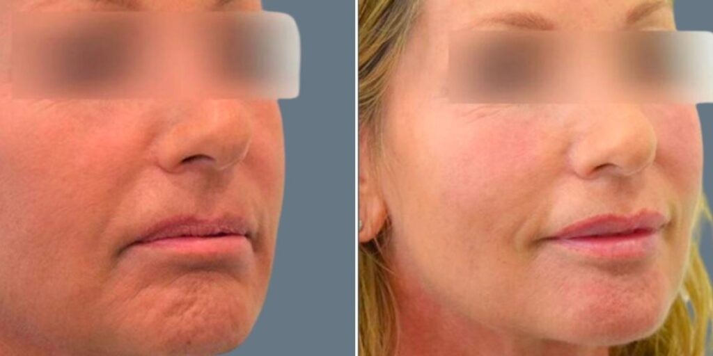 Face Lip Enhancement Female Pre2024 033 Before And After