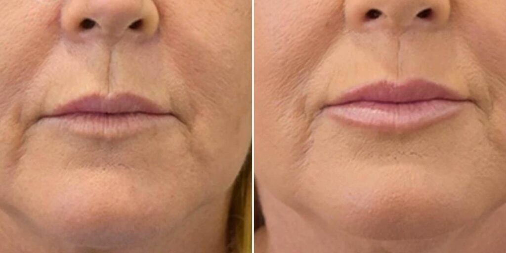 Face Lip Enhancement Female Pre2024 034 Before And After