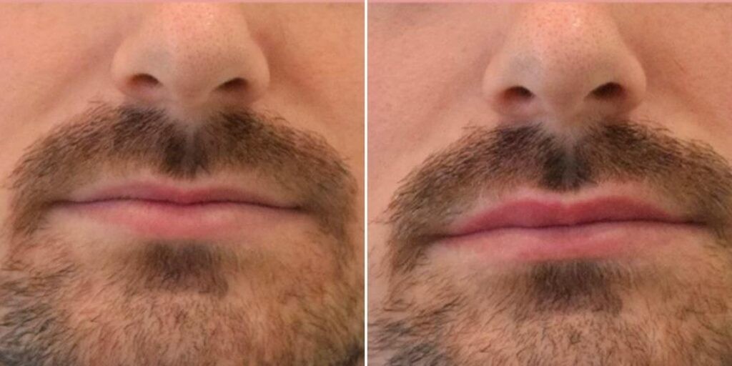 Face Lip Enhancement Male Pre2024 018 Before And After