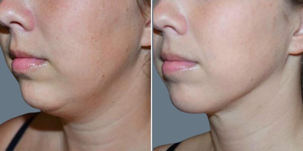 Face Lower Face Liposuction Female Pre2024 001 Before And After