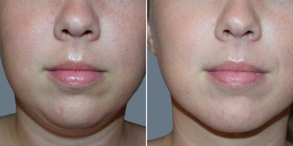 Face Lower Face Liposuction Female Pre2024 002 Before And After