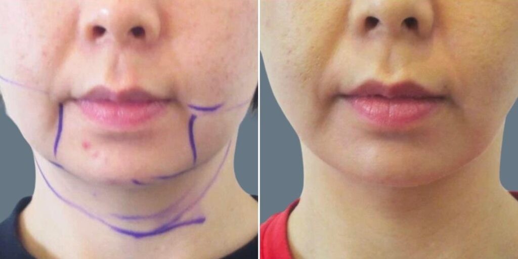 Face Lower Face Liposuction Female Pre2024 003 Before And After