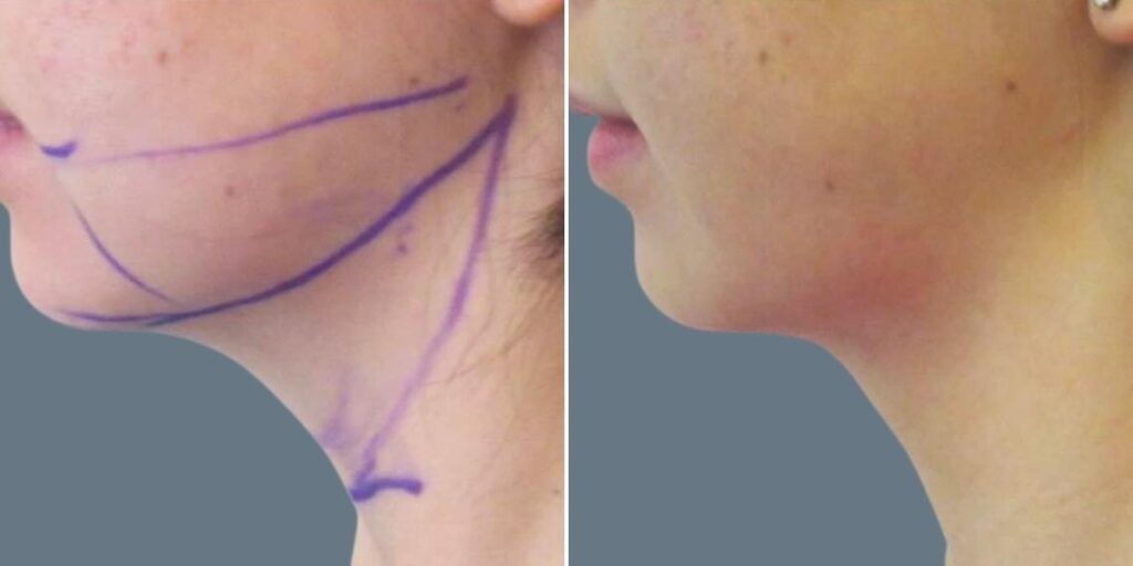 Face Lower Face Liposuction Female Pre2024 004 Before And After