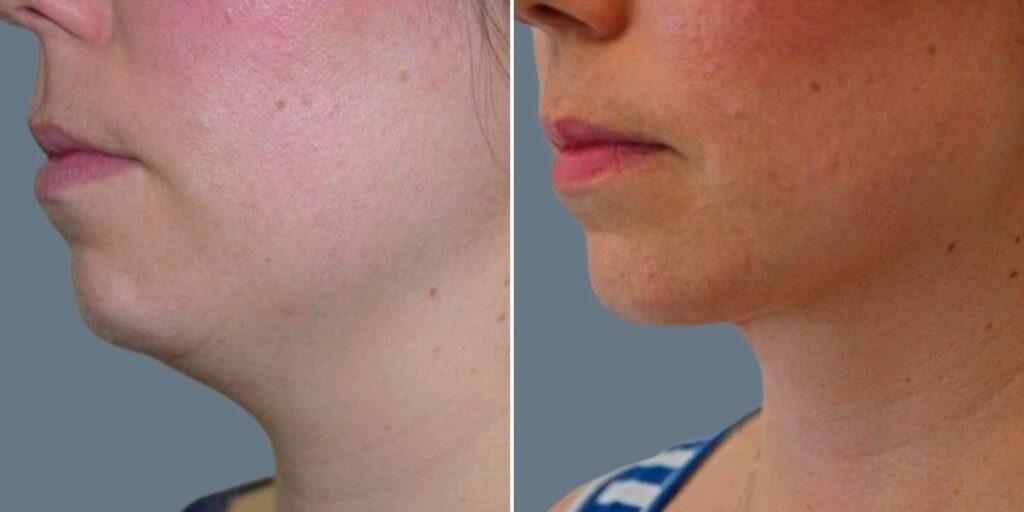 Face Lower Face Liposuction Female Pre2024 007 Before And After