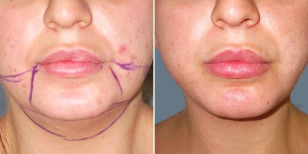 Face Lower Face Liposuction Female Pre2024 008 Before And After