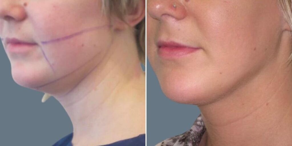 Face Lower Face Liposuction Female Pre2024 009 Before And After
