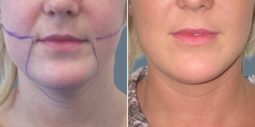Face Lower Face Liposuction Female Pre2024 010 Before And After