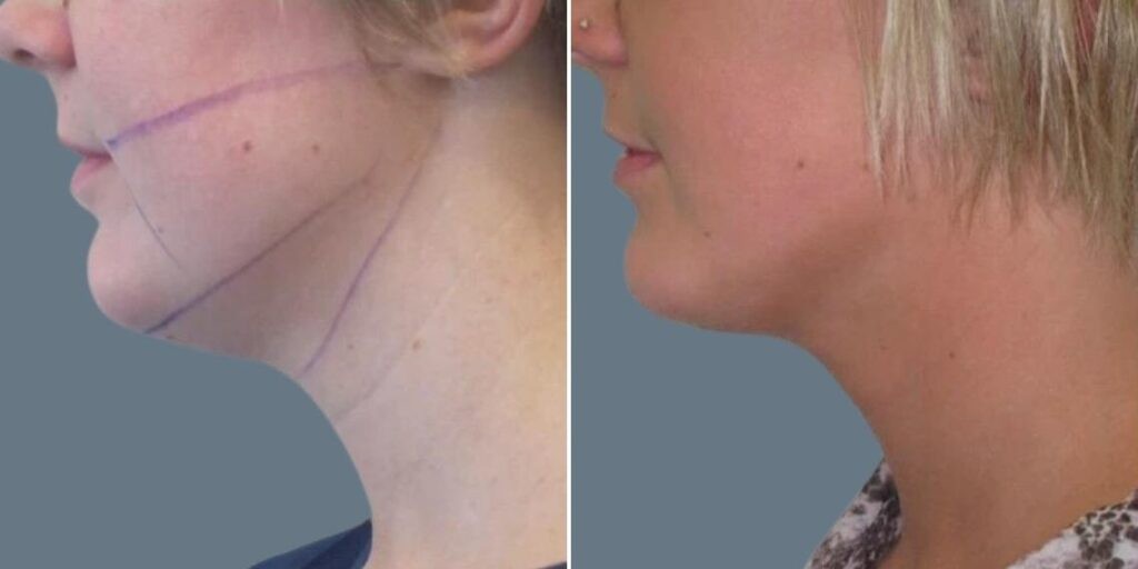 Face Lower Face Liposuction Female Pre2024 011 Before And After