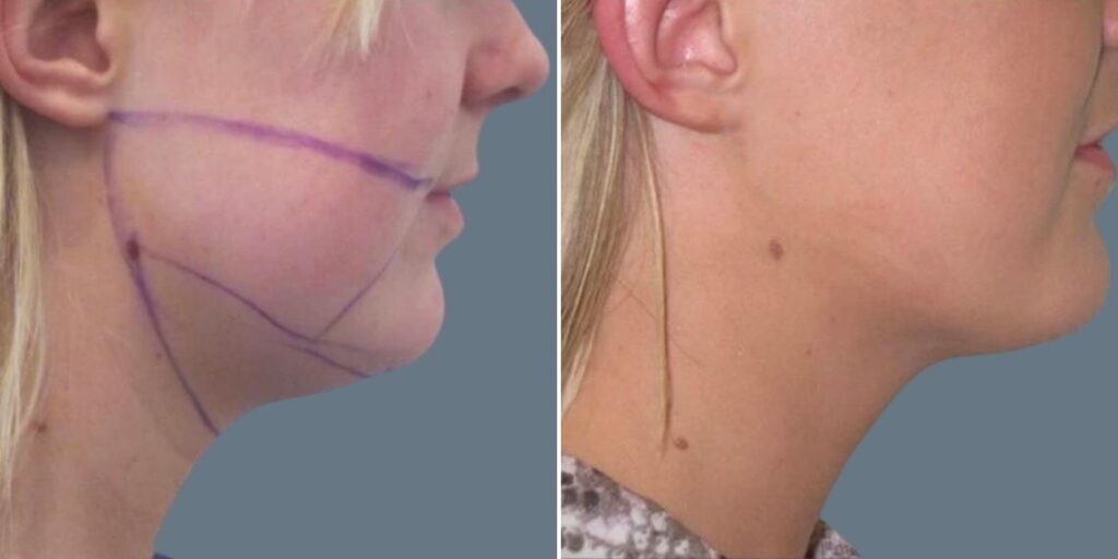 Face Lower Face Liposuction Female Pre2024 012 Before And After
