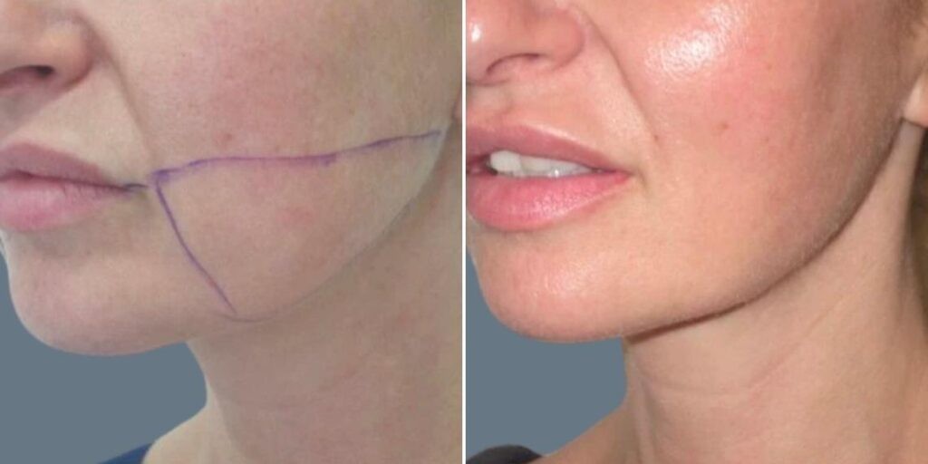 Face Lower Face Liposuction Female Pre2024 013 Before And After