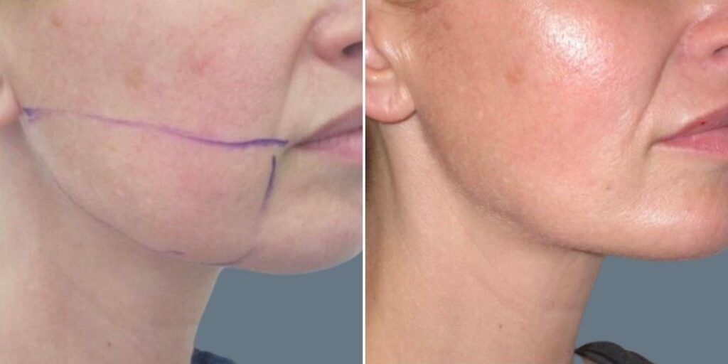 Face Lower Face Liposuction Female Pre2024 014 Before And After