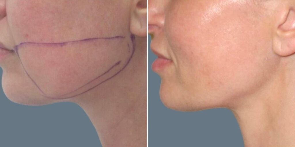 Face Lower Face Liposuction Female Pre2024 015 Before And After