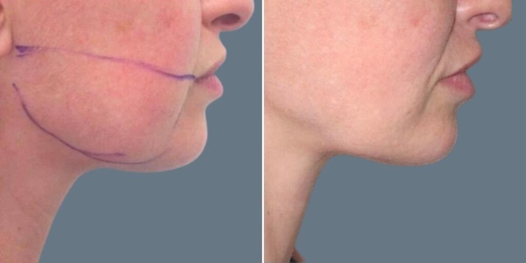 Face Lower Face Liposuction Female Pre2024 016 Before And After