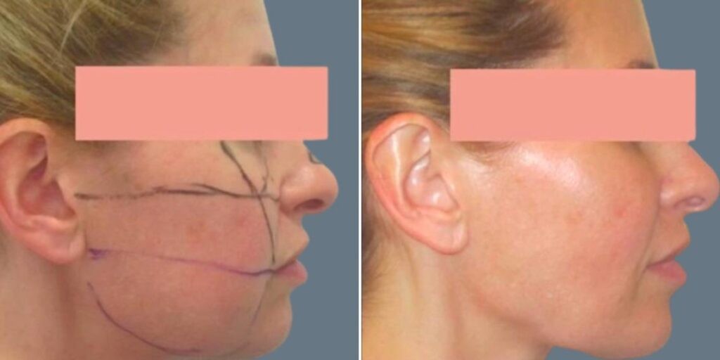 Face Lower Face Liposuction Female Pre2024 017 Before And After
