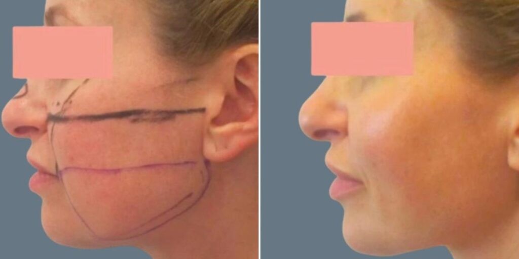 Face Lower Face Liposuction Female Pre2024 018 Before And After