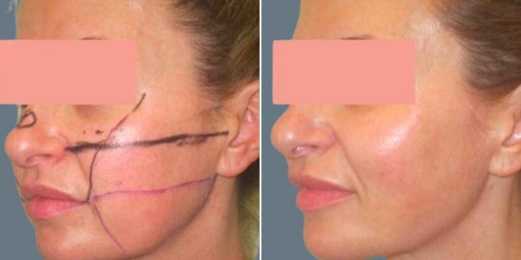 Face Lower Face Liposuction Female Pre2024 019 Before And After