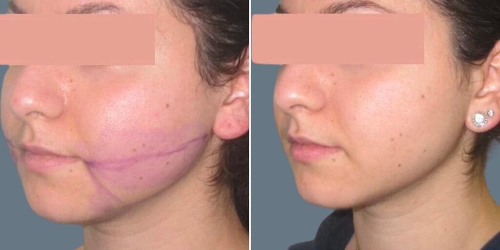 Face Lower Face Liposuction Female Pre2024 020 Before And After