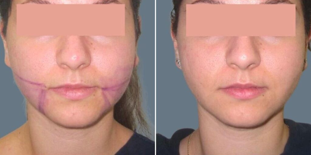 Face Lower Face Liposuction Female Pre2024 021 Before And After