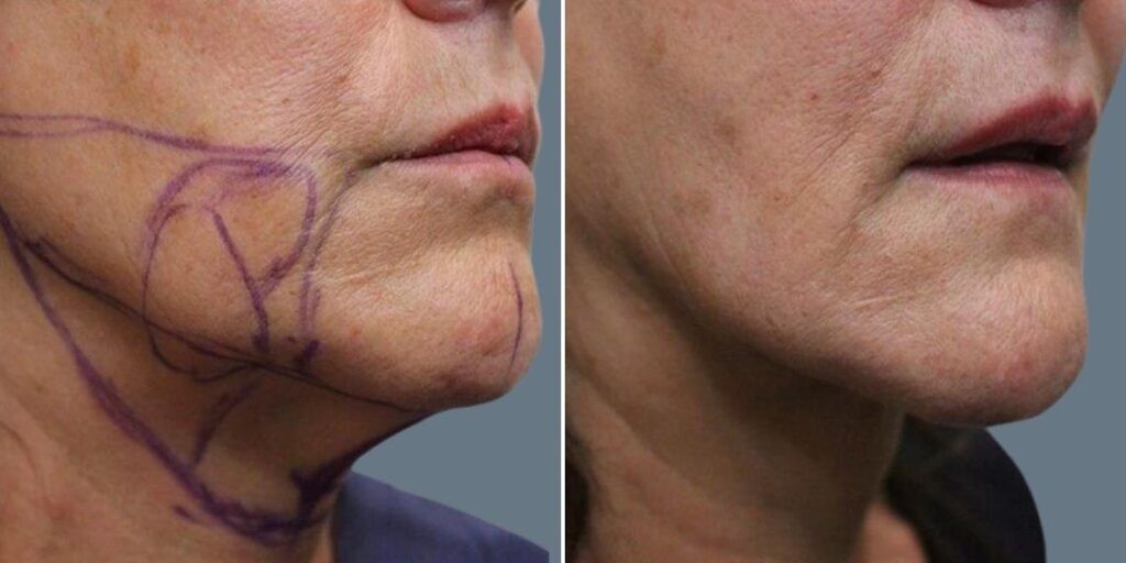 Face Lower Face Liposuction Female Pre2024 022 Before And After