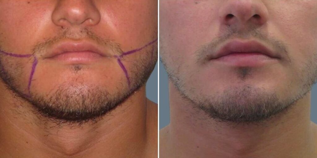 Face Lower Face Liposuction Male Pre2024 005 Before And After