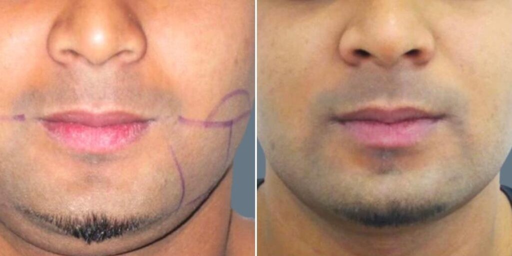 Face Lower Face Liposuction Male Pre2024 006 Before And After