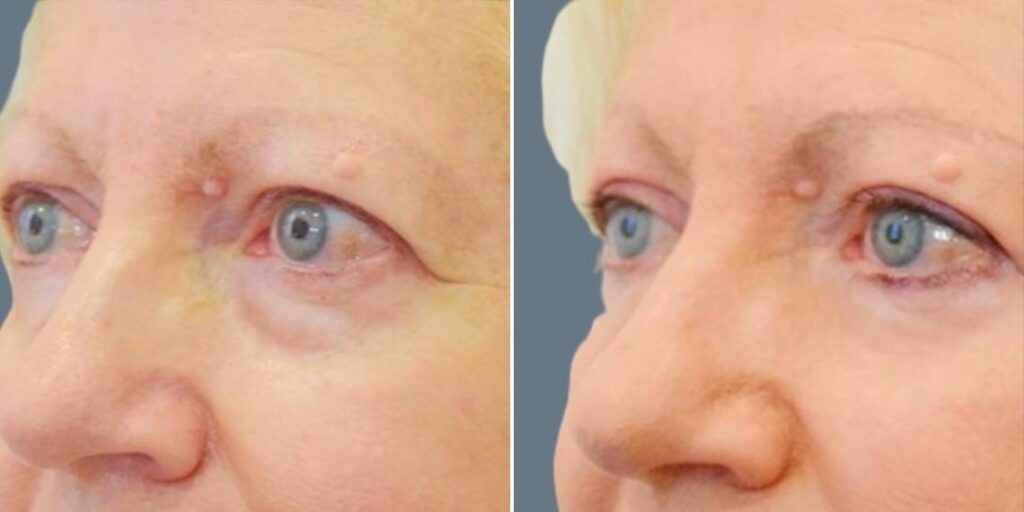 Face Non Surgical Eyelid Lift Female Pre2024 001 Before And After