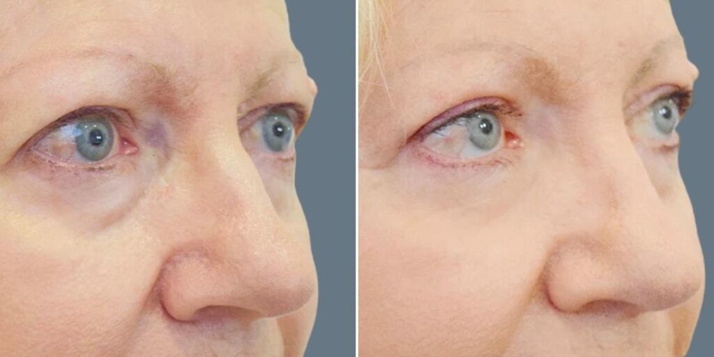 Face Non Surgical Eyelid Lift Female Pre2024 002 Before And After
