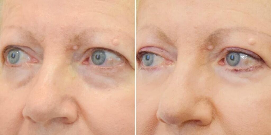 Face Non Surgical Eyelid Lift Female Pre2024 003 Before And After