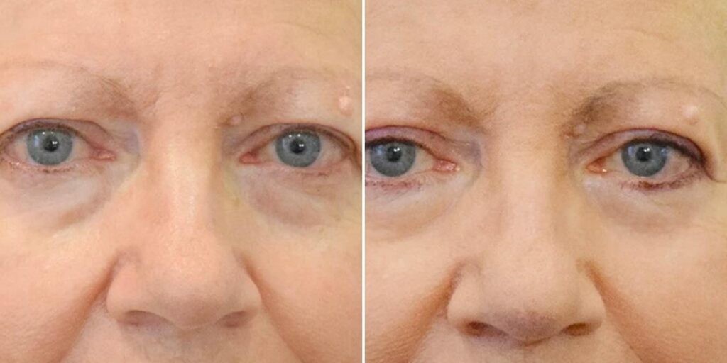 Face Non Surgical Eyelid Lift Female Pre2024 004 Before And After