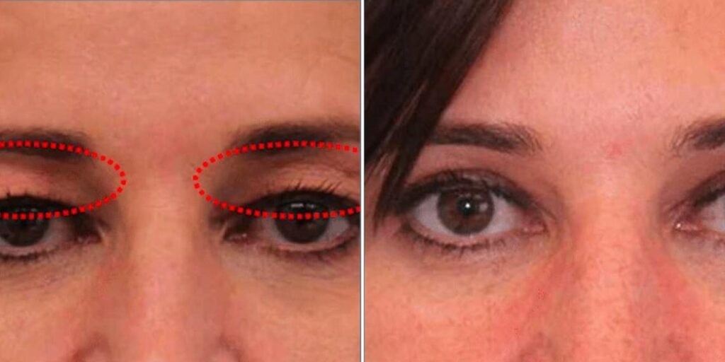 Face Non Surgical Eyelid Lift Female Pre2024 005 Before And After