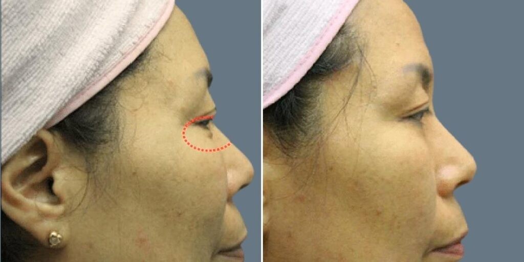 Face Non Surgical Eyelid Lift Female Pre2024 007 Before And After