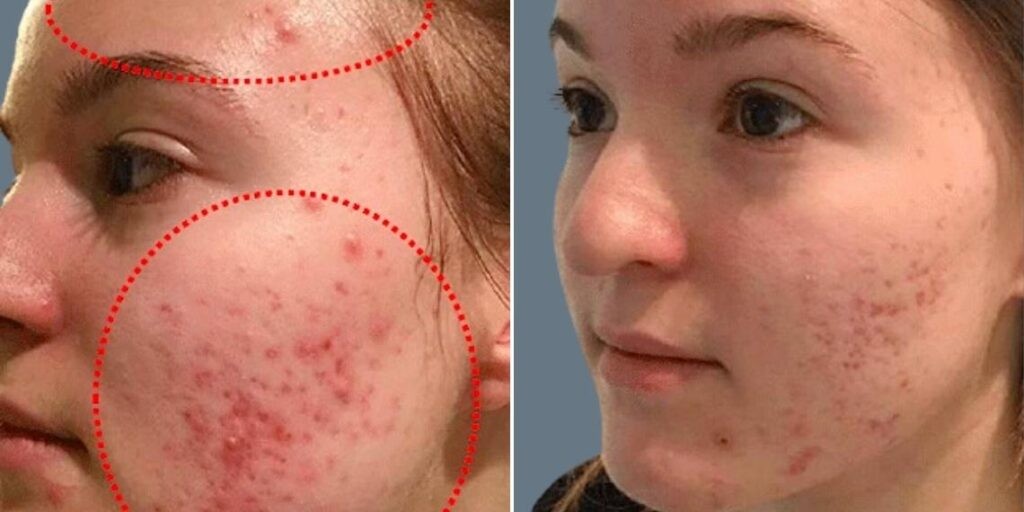 Face Non Surgical Eyelid Lift Female Pre2024 008 Before And After