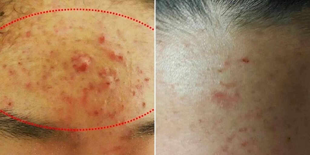 Face Non Surgical Eyelid Lift Female Pre2024 009 Before And After