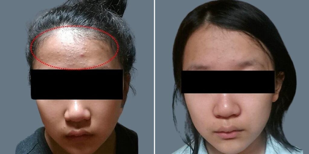 Face Non Surgical Eyelid Lift Female Pre2024 010 Before And After