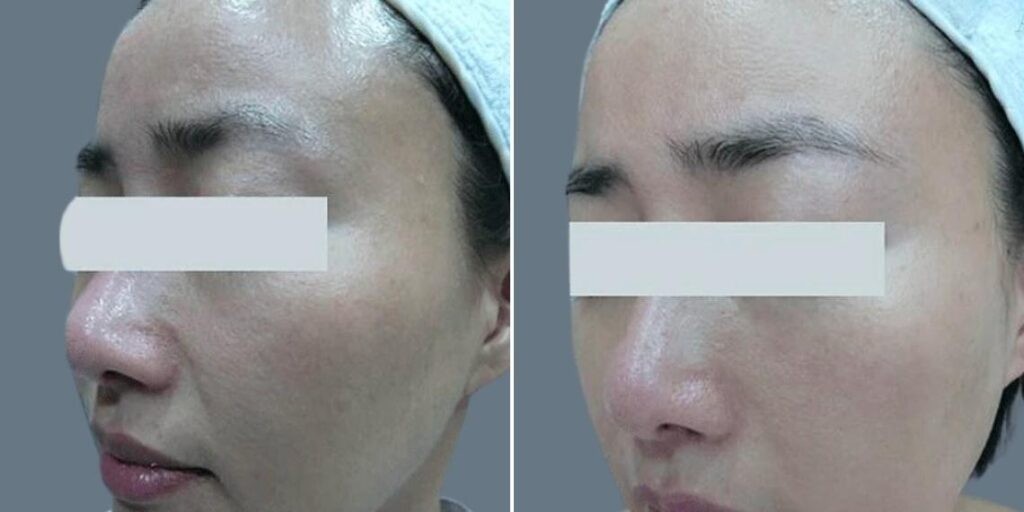 Face Non Surgical Eyelid Lift Female Pre2024 015 Before And After
