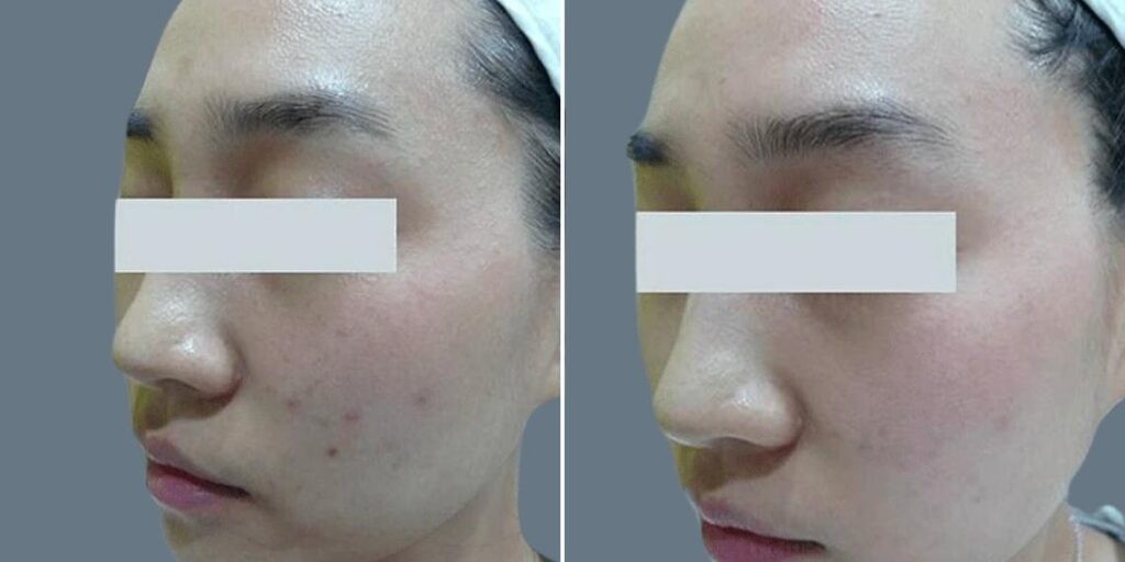Face Non Surgical Eyelid Lift Female Pre2024 016 Before And After
