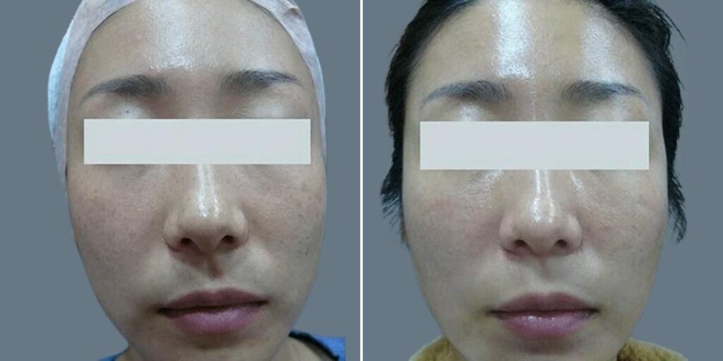 Face Non Surgical Eyelid Lift Female Pre2024 017 Before And After