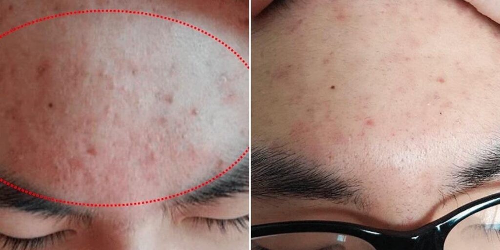 Face Non Surgical Eyelid Lift Male Pre2024 011 Before And After