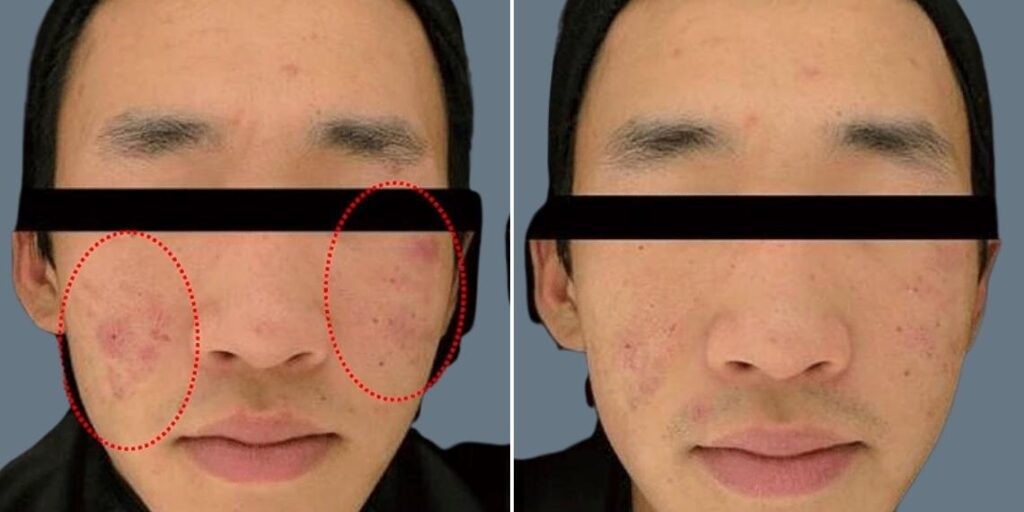 Face Non Surgical Eyelid Lift Male Pre2024 012 Before And After