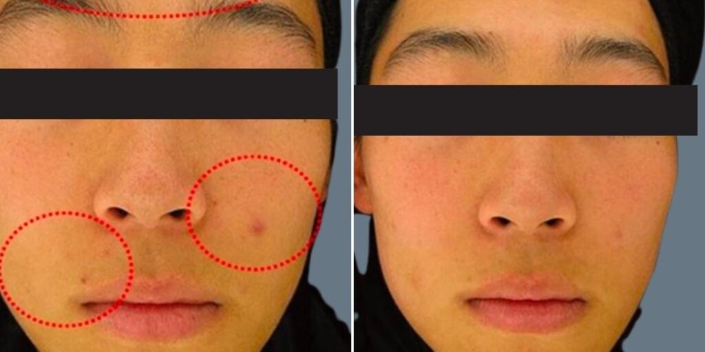 Face Non Surgical Eyelid Lift Male Pre2024 013 Before And After