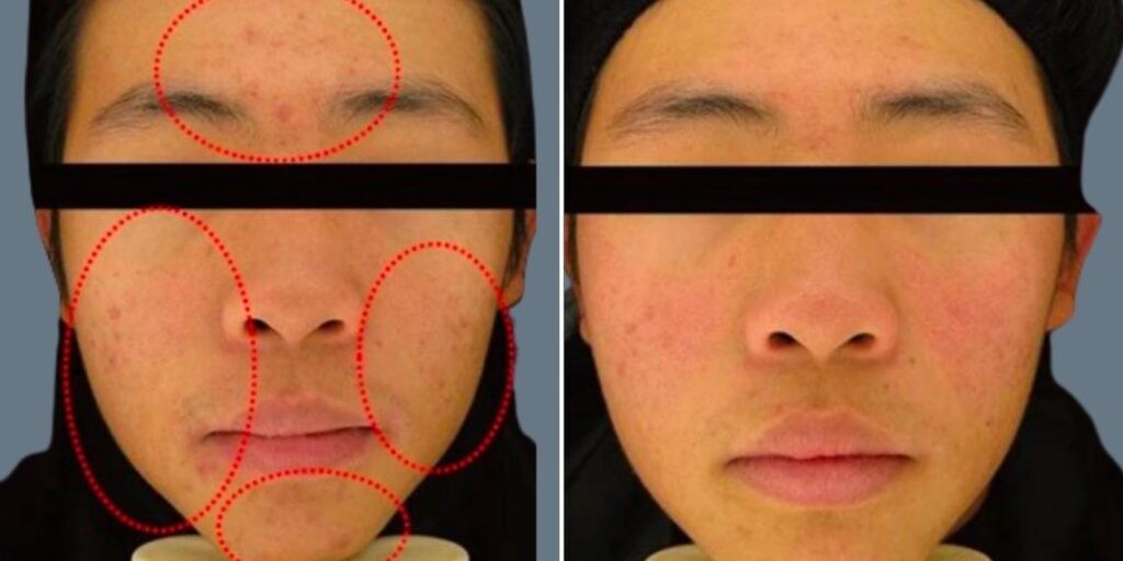 Face Non Surgical Eyelid Lift Male Pre2024 014 Before And After