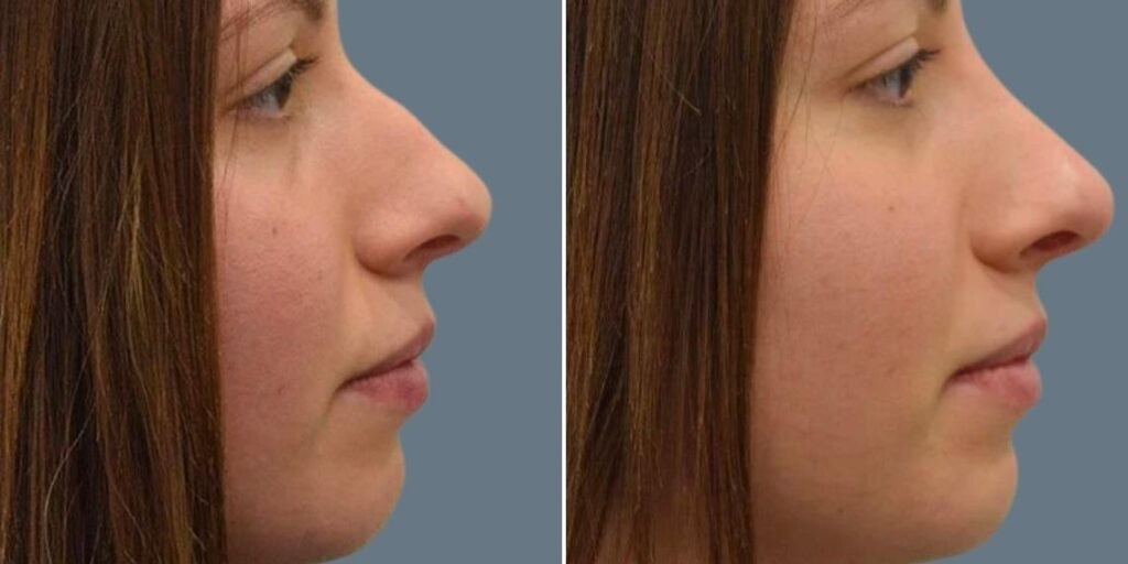 Face Non Surgical Nose Reshape Female Pre2024 001 Before And After