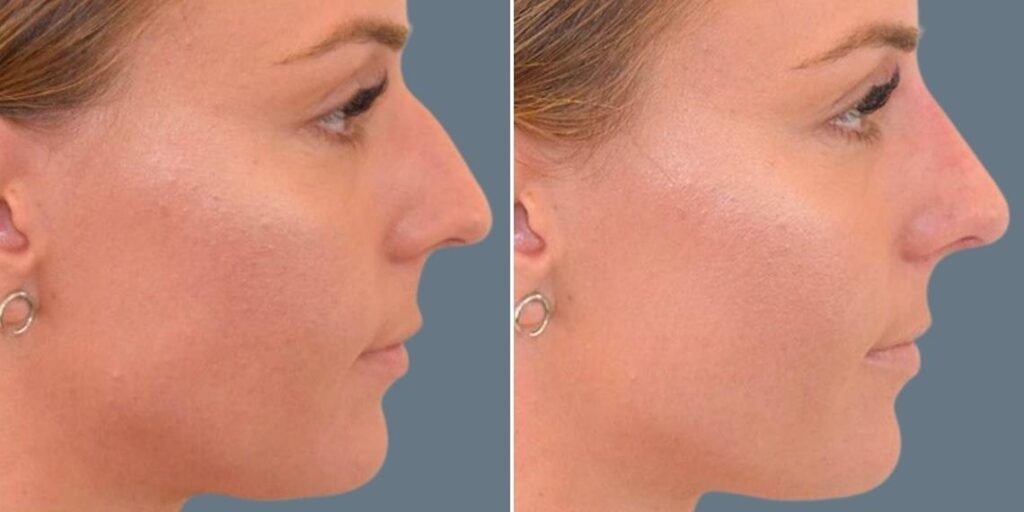 Face Non Surgical Nose Reshape Female Pre2024 003 Before And After