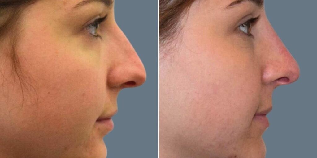 Face Non Surgical Nose Reshape Female Pre2024 005 Before And After