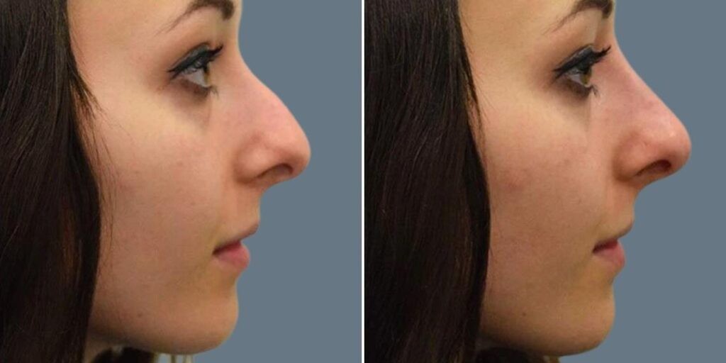 Face Non Surgical Nose Reshape Female Pre2024 006 Before And After