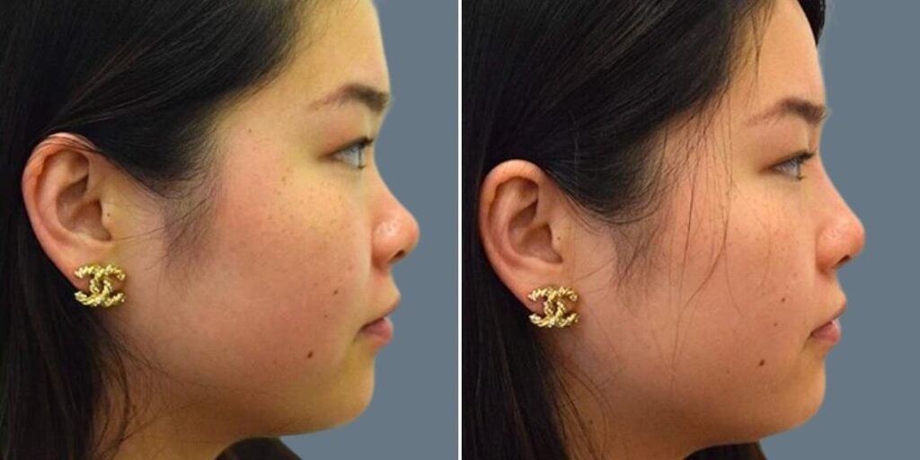 Face Non Surgical Nose Reshape Female Pre2024 007 Before And After